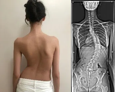 Bel Ağrısı Neden Olur? Fizyoterapist Gözüyle Tanı, Tedavi ve Korunma